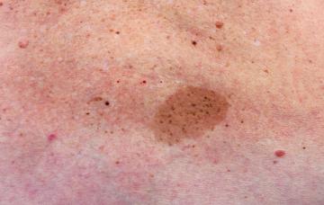 Síntomas de la neurofibromatosis tipo 1 (NF1) Síntomas de la neurofibromatosis tipo 1 (NF1)