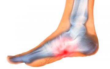 Síntomas de la osteomielitis