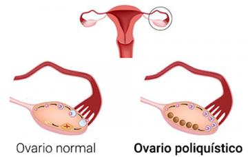 Síntomas del síndrome de ovario poliquístico Síntomas del síndrome de ovario poliquístico