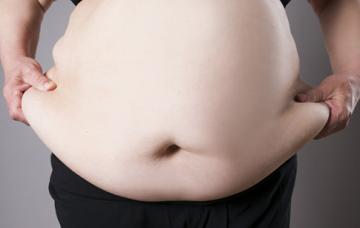Síntomas del síndrome metabólico Obesidad abdominal