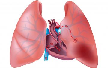 Síntomas del tromboembolismo pulmonar