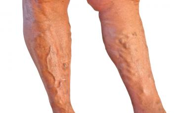 Síntomas de trombosis venosa en las piernas