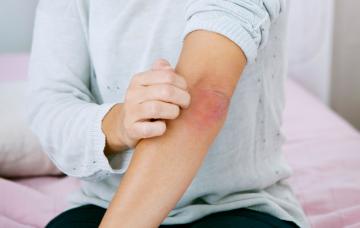Síntomas de urticaria Síntomas de urticaria en el brazo