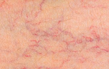 Síntomas de varices en la piel