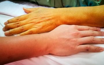 Síntomas de la insuficiencia hepática