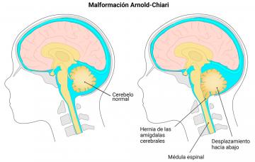 Causas de la siringomielia en el cerebro