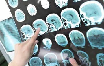 Tratamiento quirúrgico de la siringomielia