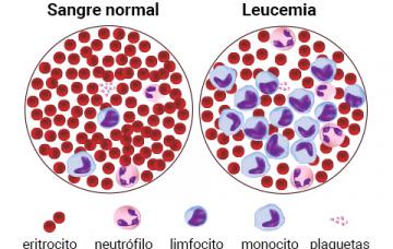 Tipos de leucemia Tipos de leucemia
