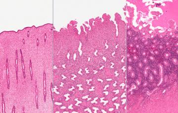 Tipos de endometriosis