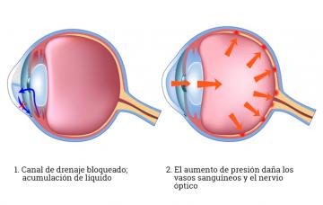 Tipos de glaucoma y causas Tipos de glaucoma y a qué se debe