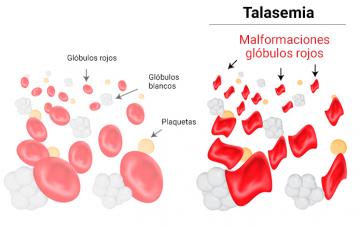Tipos de talasemias Gráfico de la talasemia