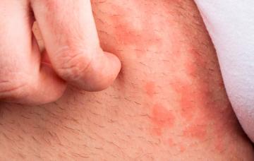 Tipos de urticaria Tipos de urticaria en la piel