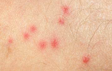 Señales de infección por enfermedad de Chagas Transmisión de la enfermedad de Chagas