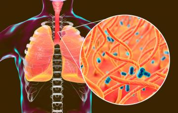 Causas de la traqueítis