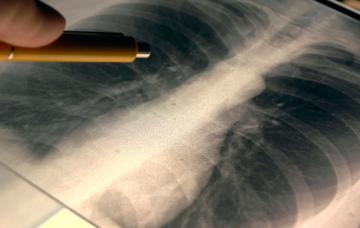 Diagnóstico de la traqueítis