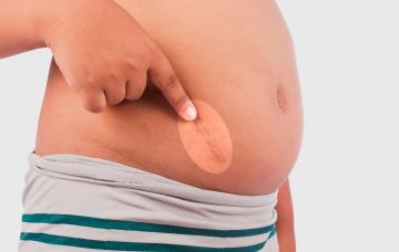 Operación de apendicitis