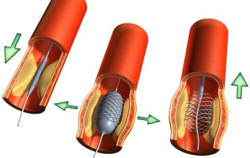 Colocación de un stent Tratamiento de la arteriosclerosis