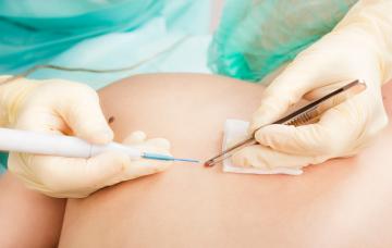 Tratamiento del cáncer de piel Tratamiento del cáncer de piel