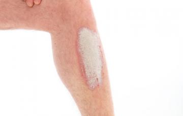 Tratamiento de una dermatitis atópica