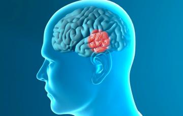 Dopaminérgicos para tratar el síndrome de piernas inquietas Tratamiento del síndrome de piernas inquietas