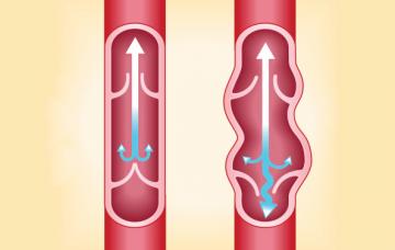 Causas de varices y retorno venoso