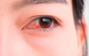 Alergias en ojos y oídos