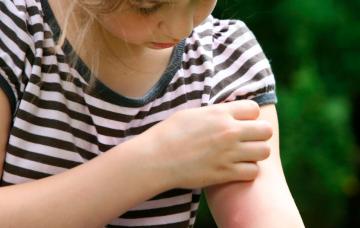 Niña pequeña con alergias cutáneas