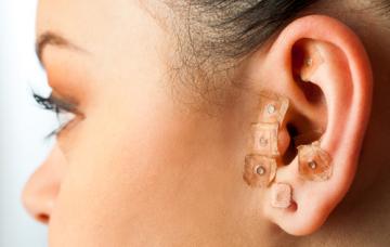 Mujer con microesferas magnéticas en la oreja