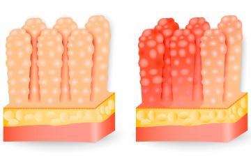 Causas de la gastroenteritis aguda