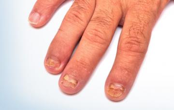 Causas de la onicomicosis