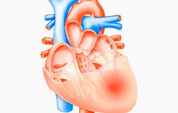 Corazón afectado por pericarditis Causas de la pericarditis