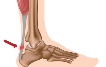 Diagnóstico de una tendinitis Gráfico de los síntomas de una tendinitis