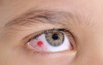 Cuerpo extraño en el ojo Señal de un cuerpo extraño en ojos