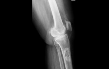 Diagnóstico del cáncer óseo