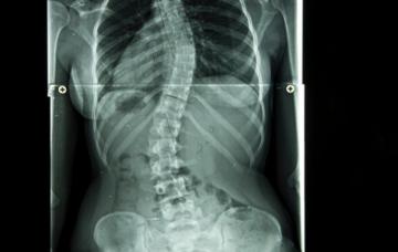 Diagnóstico de la escoliosis