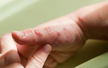Médico examinando la mano de un niño afectado por el herpes zóster