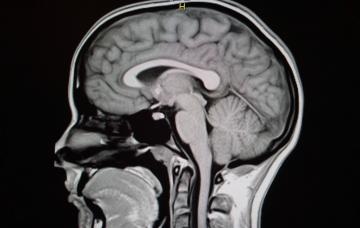 Diagnóstico de la neuralgia del trigémino Diagnóstico de la neuralgia del trigémino