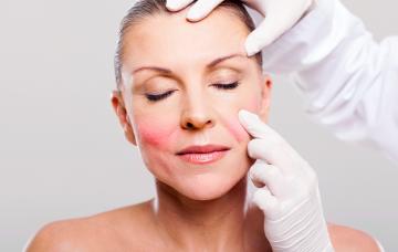 Diagnóstico de la rosácea en el dermatólogo