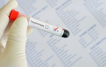 Diagnóstico de la tricomoniasis Detección de la tricomoniasis