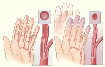 Síntomas y signos de la esclerodermia Síntomas de esclerodermia