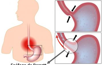 Gráfico del esófago de Barrett
