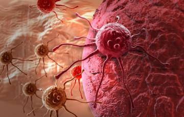 Extensión del tumor en el esófago Pronóstico del cáncer de esófago