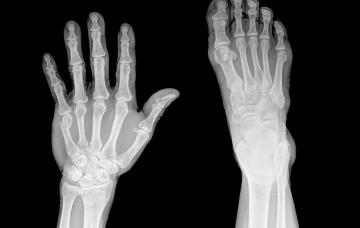 Fractura de dedo Radiografías de fractura de dedo