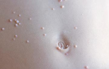 Niño con molusco contagioso