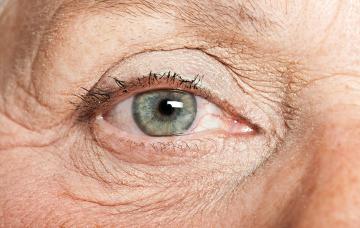 Qué es el síndrome del ojo seco