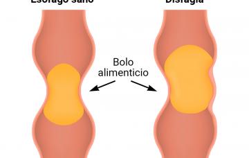 Disfagia: ilustración