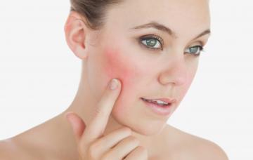 Mujer con rosácea