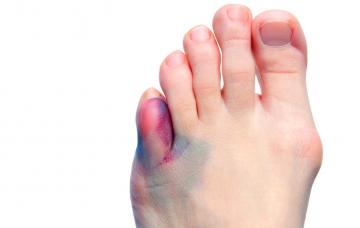 Signos y síntomas de una fractura de dedo Síntomas de una fractura de dedo