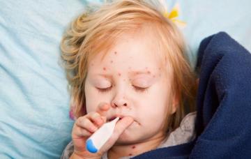 Síntomas del síndrome de Reye y diagnóstico