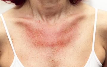 Síntomas de la alergia al sol Mujer con el pecho enrojecido por alergia al sol
